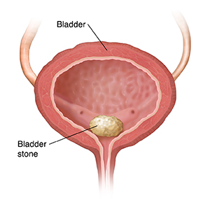 Coronal section of bladder showing bladder stone. SOURCE:  Original art. Used in 9A12236, 82987, versions in 4C940397, 5B940397, 4A940397, 90920