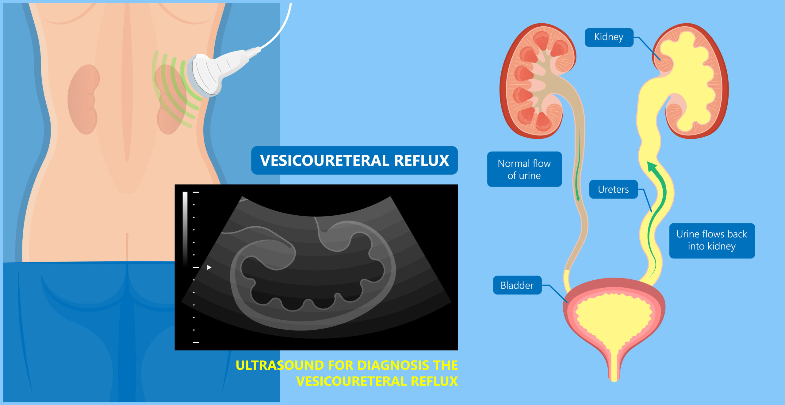 Kidney,Damage,Uti,Scan,Test,Tube,Vcug,Acute,Vur,Cyst