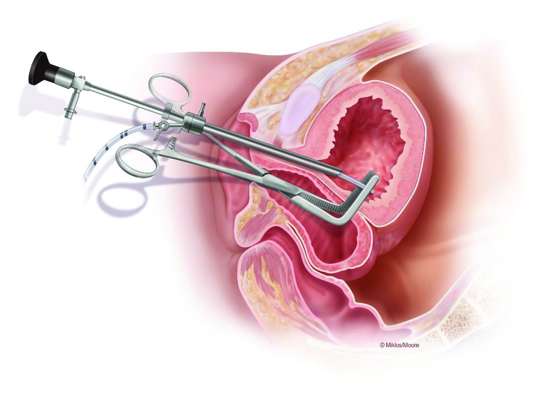 Using a right angle clamp and a cystoscope confirms the fistula